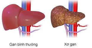 Bệnh xơ gan, nguyên nhân, triệu chứng, giai đoạn và cách phòng ngừa