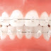 Phổ biến hiện nay hai loại niềng răng sứ thẩm mỹ