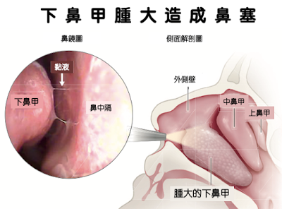 過敏性鼻炎造成鼻塞的原因: 下鼻甲腫大塞住