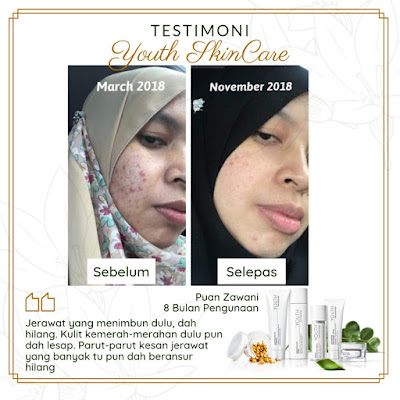 Testimoni Youth Skincare Untuk Jerawat