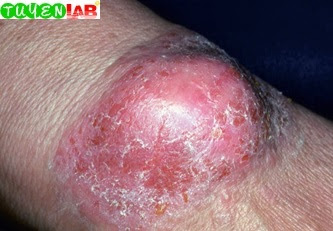Fig. 6.25 Contact allergy to adhesive in bandage