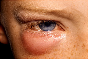 Treatment of orbital cellulitis