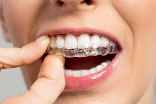 Quy trình niềng răng trong suốt-1