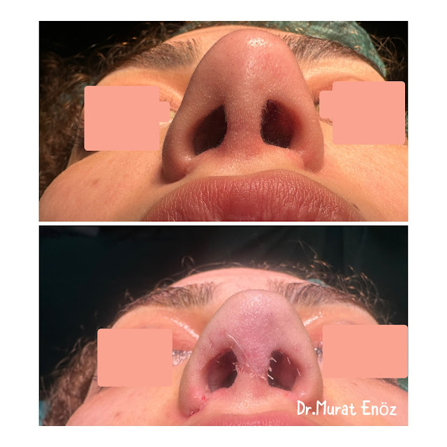 Simple revision tertiary nose aesthetic operation, tertiary nose job
