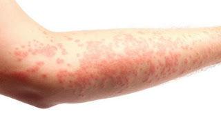 Ramuan Tradisional Yang Paling Ampuh Mengobati Alergi
