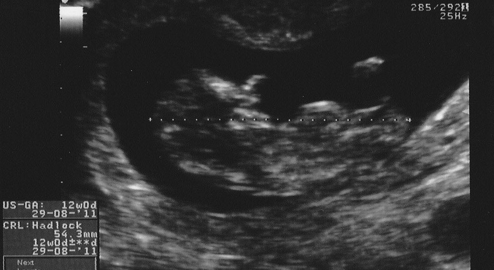 12 5 week ultrasound. Here#39;s baby at 12 weeks