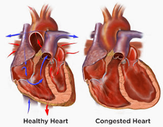 Emergency Care Plan Congestive Heart Failure