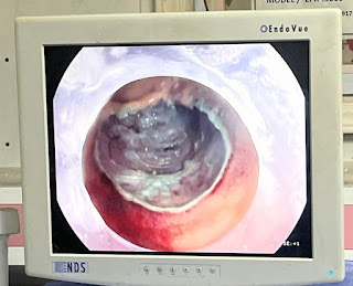 bare area after resection