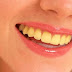 Xử lý răng ố vàng và có cao răng bảo vệ răng miệng