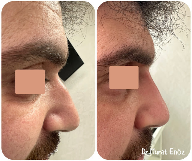 Non-surgical rhinoplasty with temporary filler in Istanbul,Injectable nose job,Liquid Rhinoplasty,