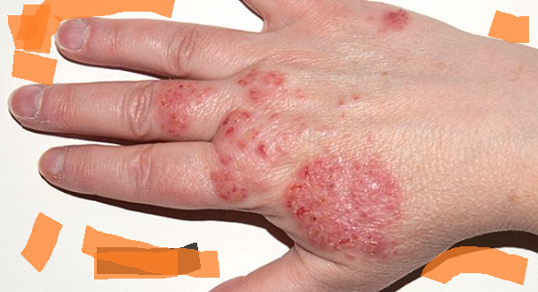 Definition, Causes, and Characteristics of Eczema Skin Disease