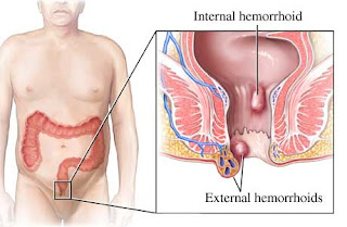 NANDA Hemorrhoids