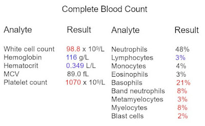 تحليل CBC لمريض لوكيميا مزمنة (سرطان الدم)