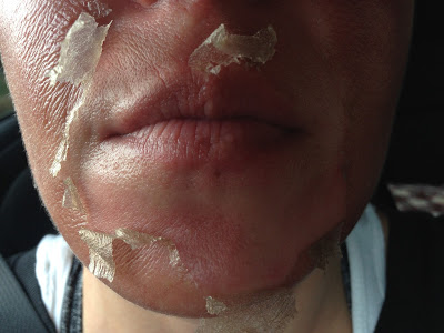 one s skin to peel,causes skin to peel,skin peel treatment