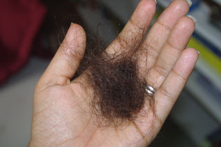 caída del cabello y calvicie