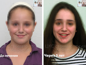 Улыбка до и после ортодонтического лечения 