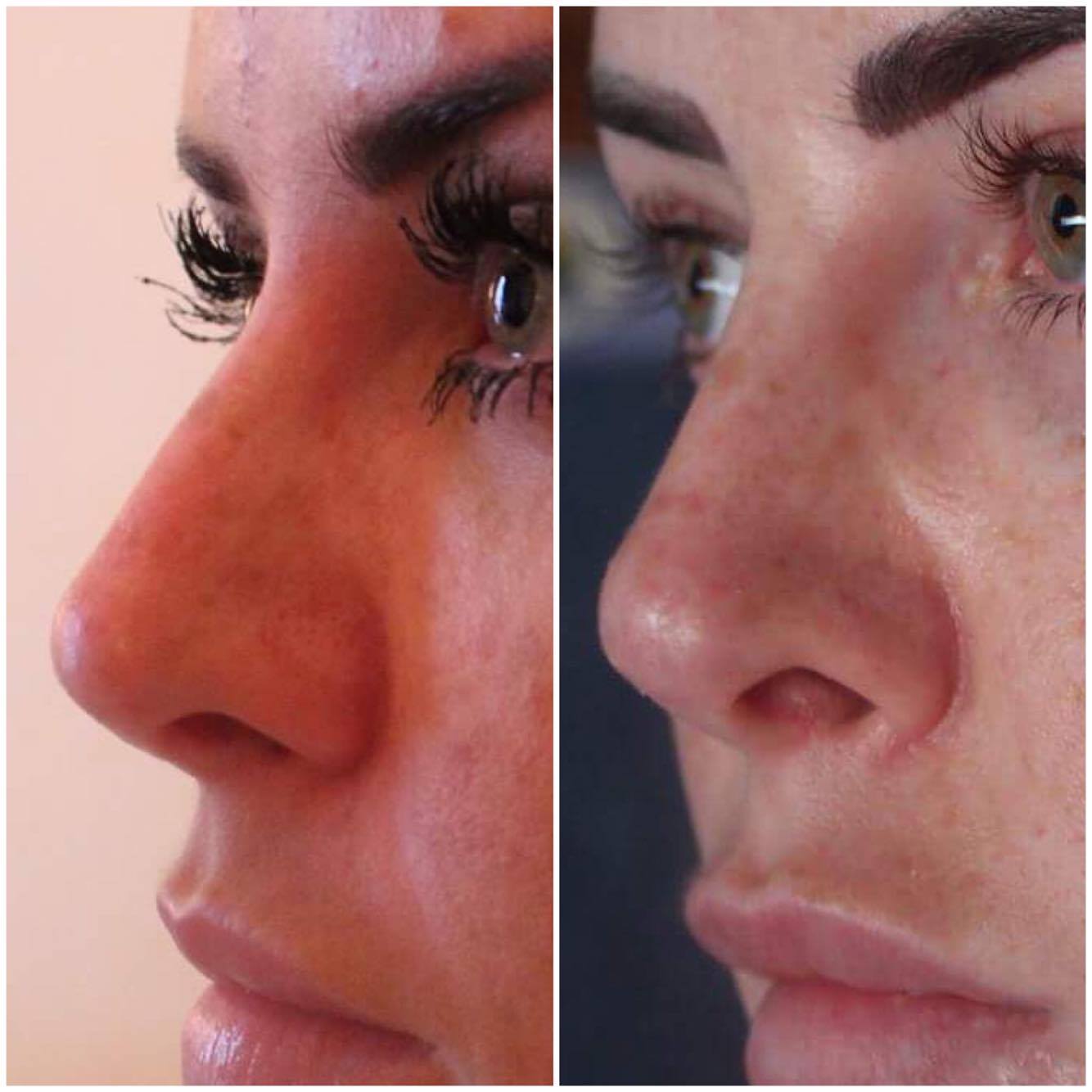 Non Surgical Rhinoplasty / Nose Job At Botonics By Naruschka Review | Before & After