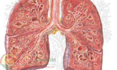 Bệnh xơ phổi là tình trạng tổn thương mãn tính tại mô phổi