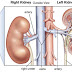 What is Kidney Failure? What are the Treatments for Kidney Failure