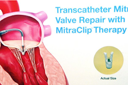 The MitraClip Shows Promise in Managing Severe Heart Failure 
