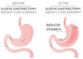 Gastric Sleeve Surgery in Delhi