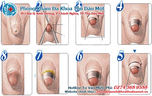 bước cắt bao quy đầu dùng công nghệ Hàn Quốc