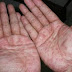 Timbul bintik-bintik merah pada tangan dan gatal