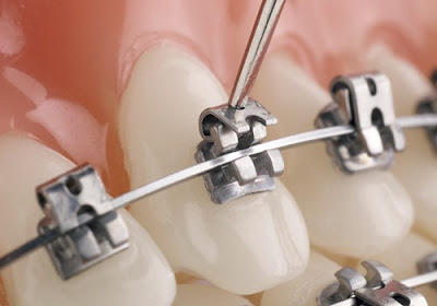 Phương thức niềng răng là gì?