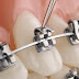 Phương thức niềng răng là gì?
