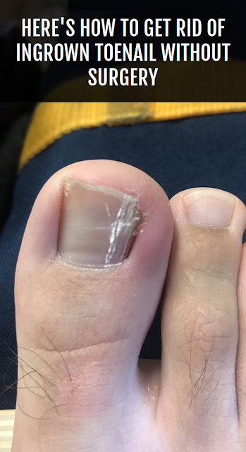 Here’s How To Get Rid Of Ingrown Toenail Without Surgery