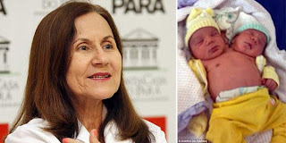 Bayi Berkepala Dua Brasil