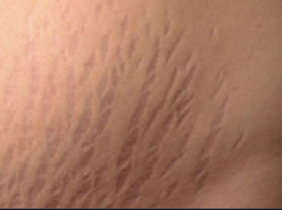 stretch mark