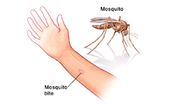 علاج لدغة البعوض في المنزل