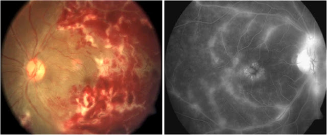 Central Eales’ disease: fundus and fluorescein angiography. The colour fundus photograph of left eye shows massive areas of retinal haemorrhages and periphlebitis in the posterior pole (left) and fluorescein angiography of the right eye shows gross staining of vessels and cystoid macular oedema (right). The colour fundus (left) shows obliterated vessels as white lines (arrows), surrounded by retinal haemorrhages; the corresponding angiogram (left) shows areas of capillary nonperfusion (arrow head) distal to the obliterated vessels.