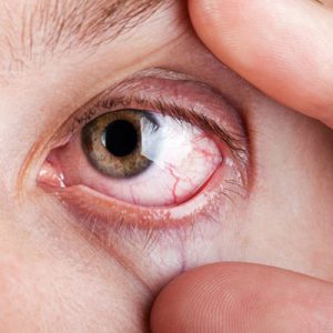 how to get rid of red eyes without eye drops
