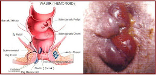 Penyebab Benjolan & Gatal di Anus serta Obat Benjolan & Gatal di Anus Tradisional 