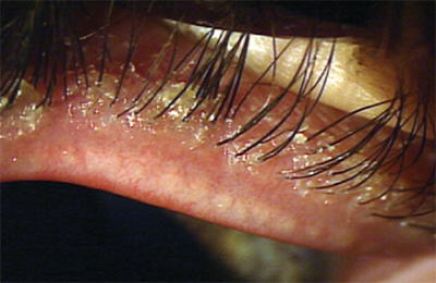 Demodex according to http://www.optometric.com/article.aspx?article=102974