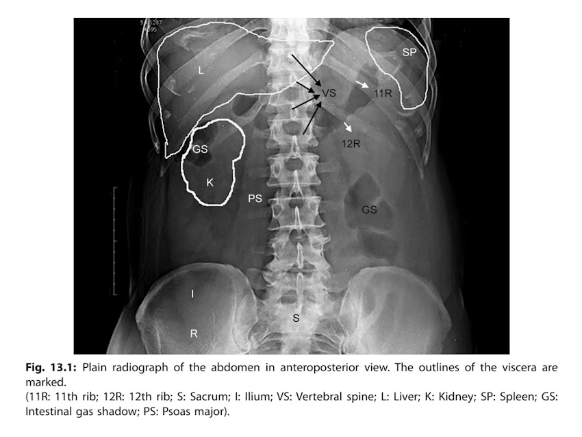 X-Rays of Abdomen