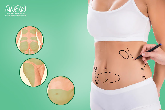 Liposuction In Bangalore