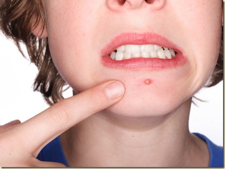 tratamiento-para-el-acne