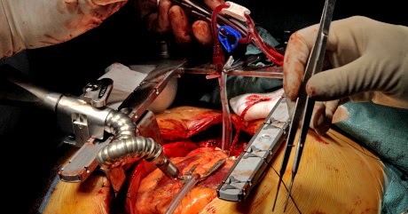 Rawatan Jantung Tersumbat Angioplasty Atau Bypass 