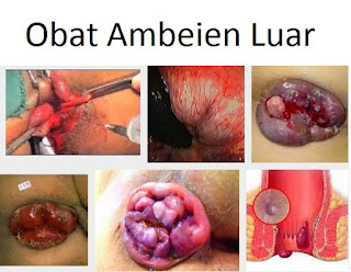 obat pengempes benjolan ambeien di anus paling manjur