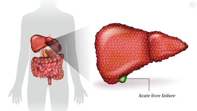 Acute Liver Failure: Symptoms and Preventions