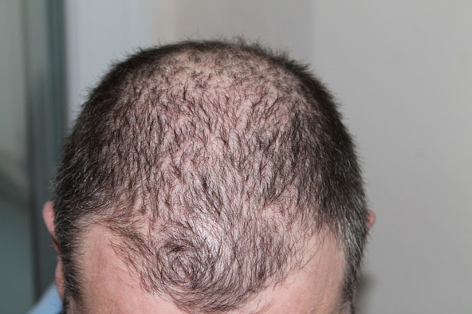 What is the Reason for Hair Loss?