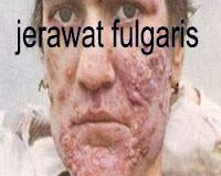 jerawat fulgaris