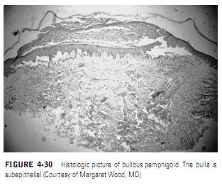 BULLOUS PEMPHIGOID