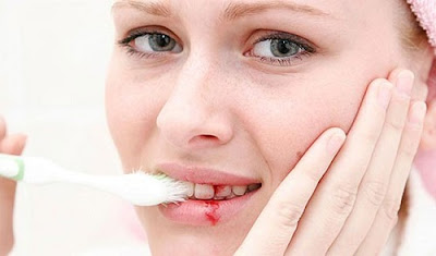 Nếu phát hiện bị chảy máu chân răng thường xuyên phải tìm hiểu ngay nguyên nhân