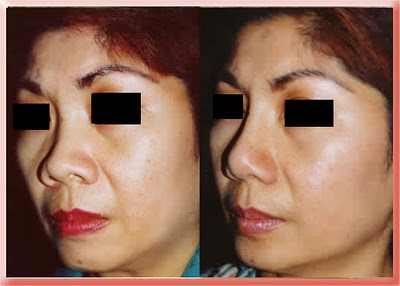 asian rhinoplasty