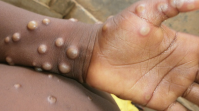 Wokepox: The WHO Is Asking For The Public's Help In Re-Naming Monkeypox