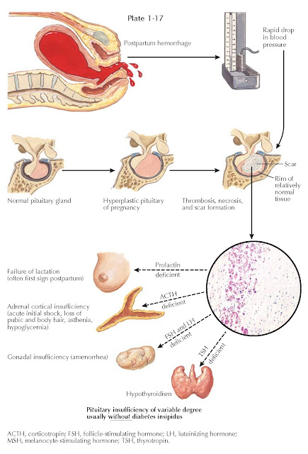 POSTPARTUM PITUITARY INFARCTION (SHEEHAN SYNDROME)